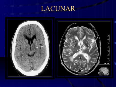 infarto lacunar cie 10