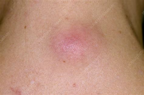 infected sebaceous cyst icd 10