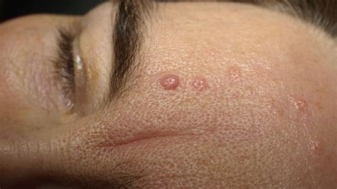 infected sebaceous cyst of skin icd 10