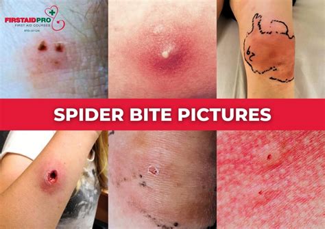 Warning Signs of an Infected Spider Bite You Should Know