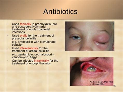 infected stye oral antibiotics