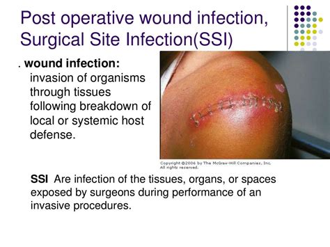 What You Need to Know About Infection After Surgery: Warning Signs and Prevention Tips
