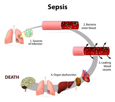 infection leading to sepsis