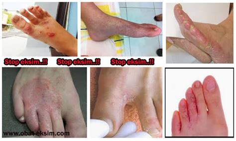 infeksi kulit pada kaki akibat bau kaki