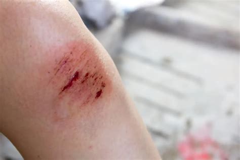 Infeksi Luka