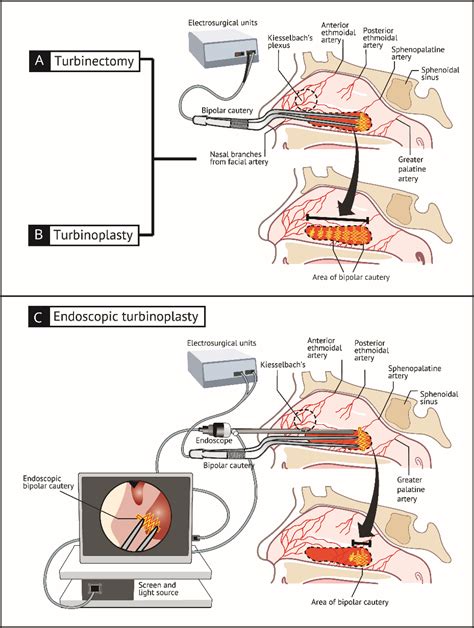 inferior turbinectomy procedure