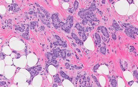 infiltrating ductal carcinoma right breast