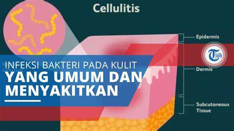Infeksi Bakteri