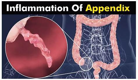Inflamed Appendix Meaning In Hindi Of Fitriblog1