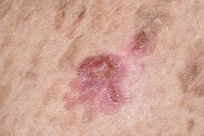 inflamed pigmented seborrheic keratosis