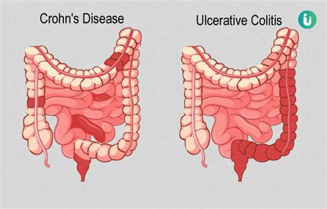 inflammatory bowel disease meaning in telugu