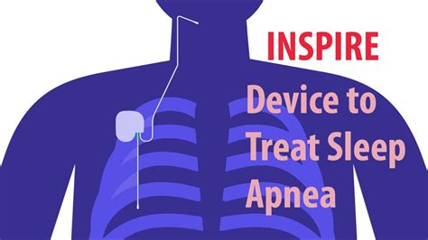 information on inspire for sleep apnea