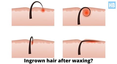 ingrown hair with waxing