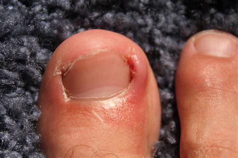 Effective Relief for Painful Ingrown Nail Toe Solutions Found