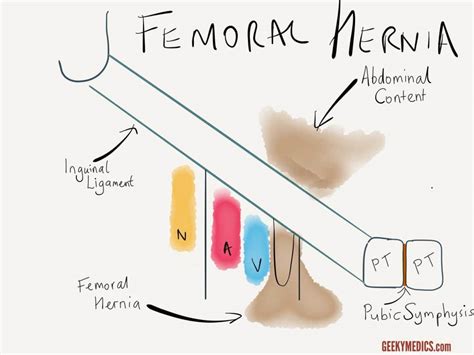 inguinal and femoral hernias