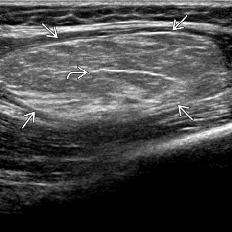 inguinal canal lipoma ultrasound