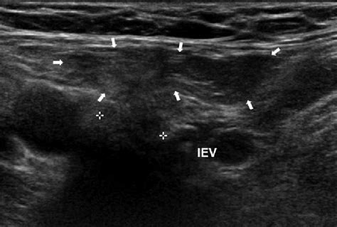inguinal canal ultrasound images