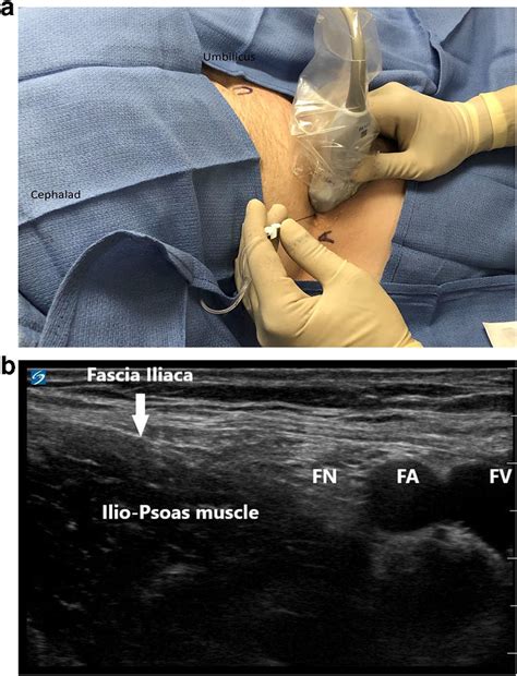 inguinal crease femoral nerve block