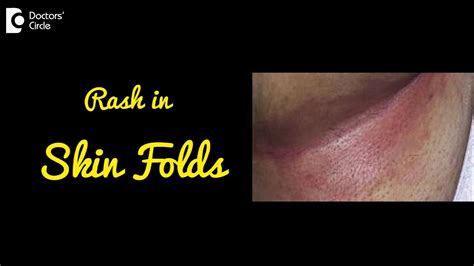 inguinal fold rash