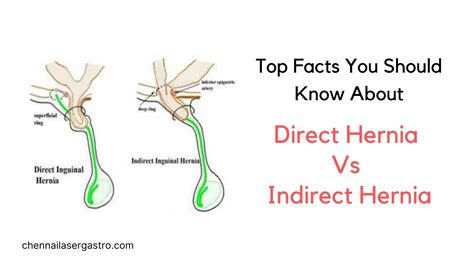 inguinal hernia indirect and direct
