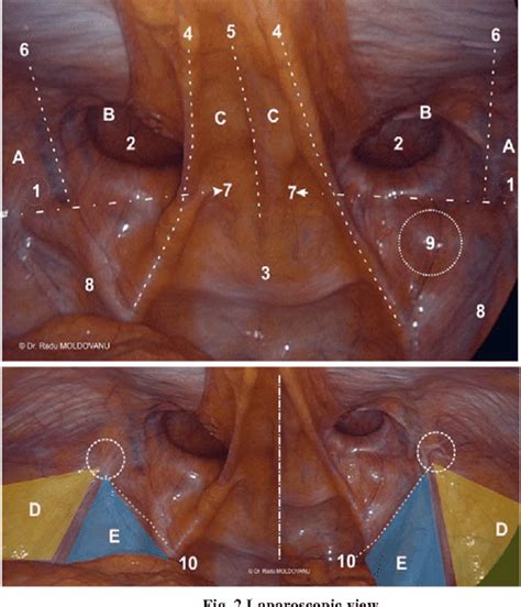 inguinal hernia laparoscopic view