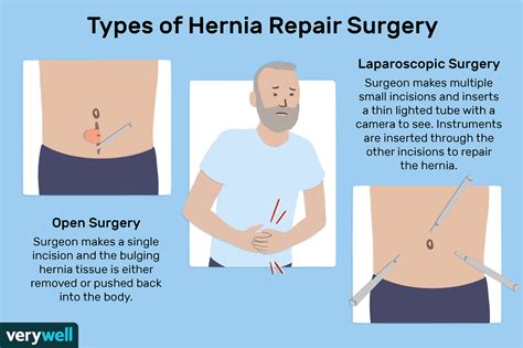 inguinal hernia repair in spanish