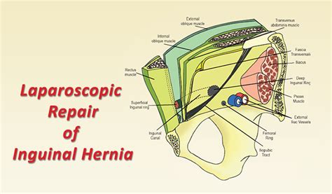 inguinal hernia repair laparoscopic procedure