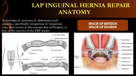 inguinal hernia repair options
