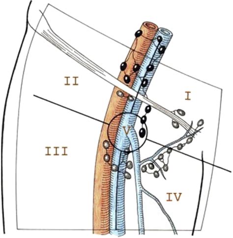 inguinal lymph node surgery