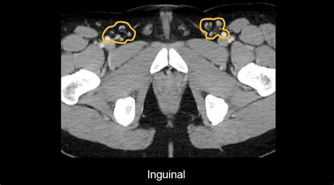 inguinal lymph nodes ct scan