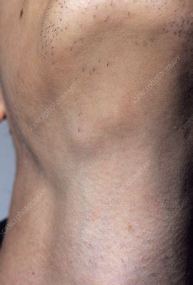 inguinal lymph nodes swelling