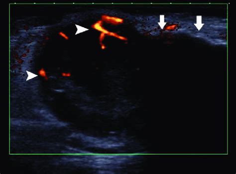 inguinal lymph nodes ultrasound