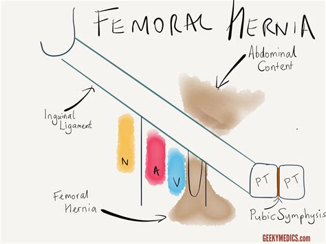 inguinal vs femoral hernias