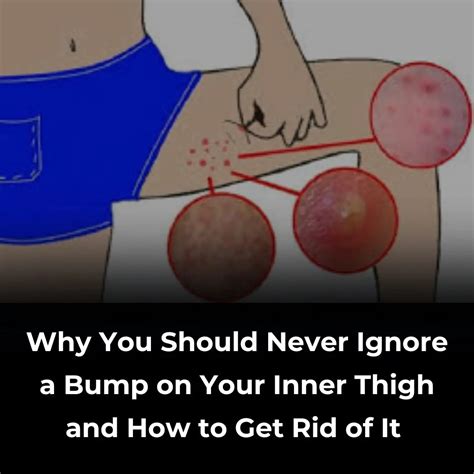 What Causes Inner Bumps on Thighs and How to Treat
