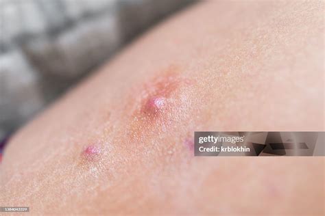 Say Goodbye to Inner Leg Pimples: Causes, Prevention, and Effective Treatments