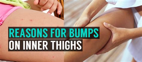 Say Goodbye to Inner Thigh Bumps: Causes, Prevention, and Effective Treatments