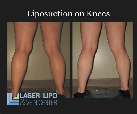 Tightening and Toning Thighs Liposuction Centre for Surgery YouTube