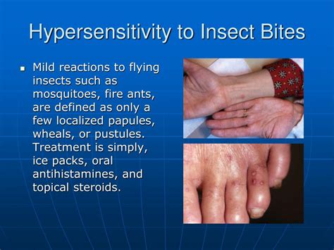 Insect Bite Hypersensitivity Type