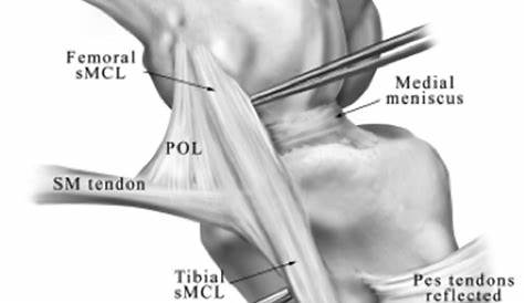 Insertion Point Of The Lateral Collateral Ligament Open Anatomic Reconstruction Medial