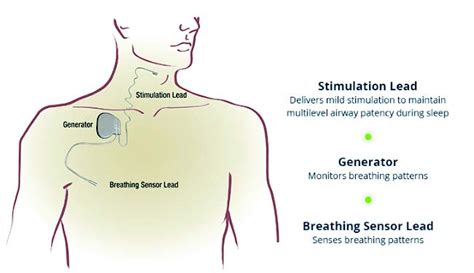 inspire sleep apnea implant cpt code