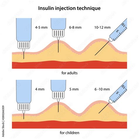 Insulin Injection Needle Length