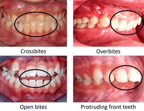Interceptive Orthodontics Examples