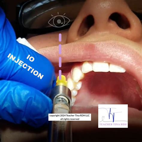 internal 6 injections
