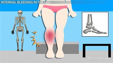 internal bleeding into a fractured extremity