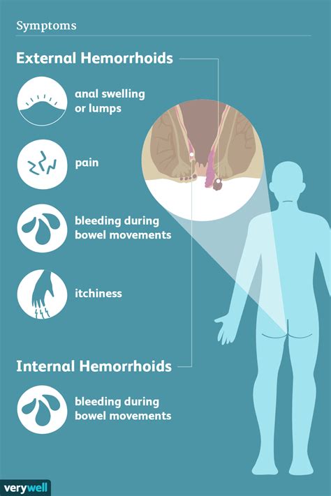 Understanding Internal Hemorrhoid Symptoms: What You Need to Know