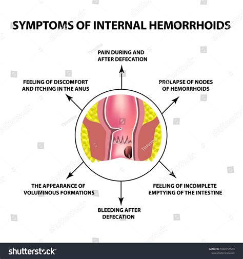 Internal Hemorrhoids Burst