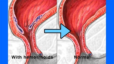 Internal Hemorrhoids Icd 10