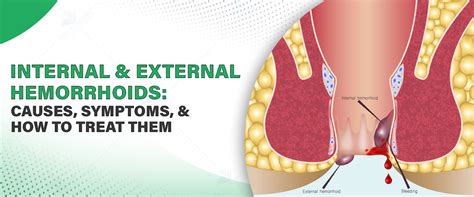 Internal Hemorrhoids Medscape