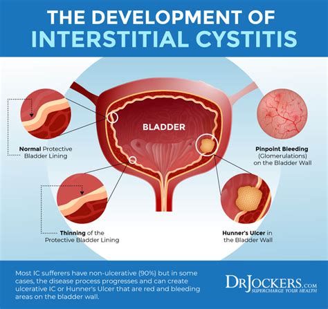 interstitial cystitis clinical trials
