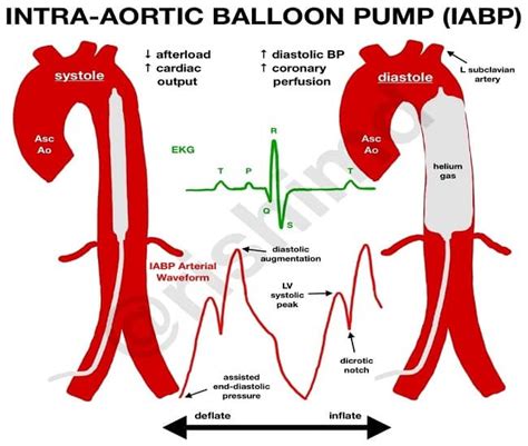 Intraaortic Balloon Pump: Life-Saving Technology in Cardiac Care